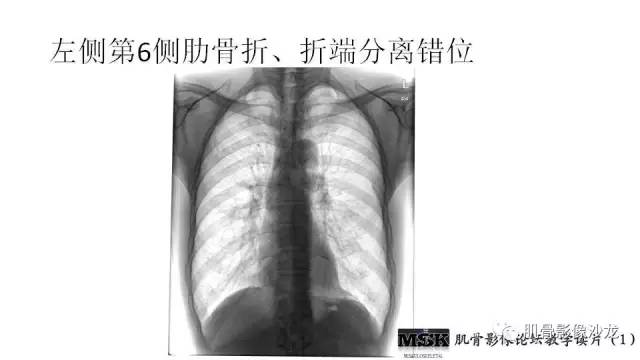 【PPT】肋骨骨折诊断经验分享