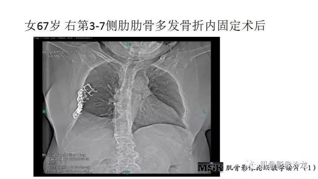 【PPT】肋骨骨折诊断经验分享