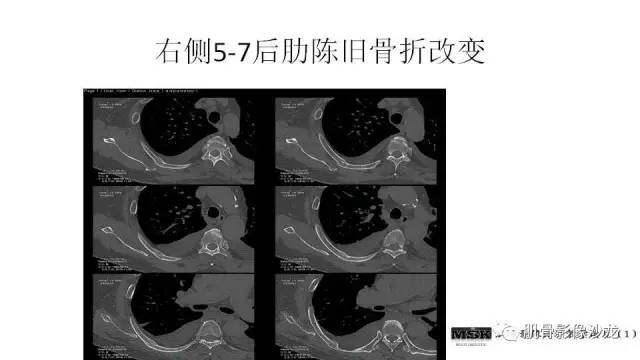 【PPT】肋骨骨折诊断经验分享