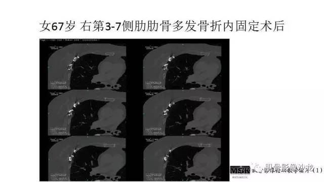 【PPT】肋骨骨折诊断经验分享
