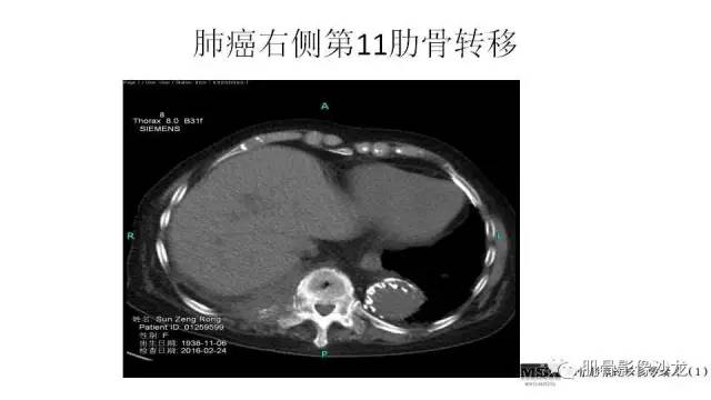 【PPT】肋骨骨折诊断经验分享