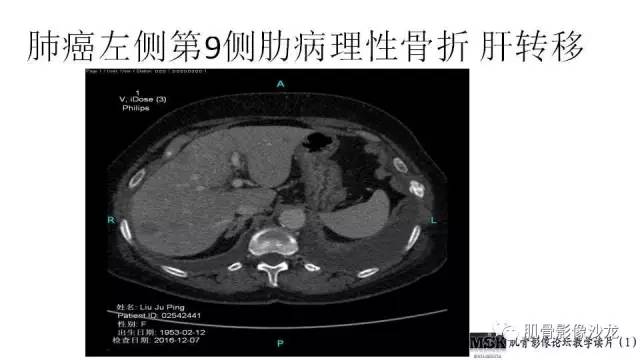 【PPT】肋骨骨折诊断经验分享