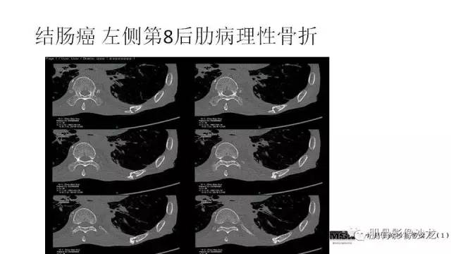 【PPT】肋骨骨折诊断经验分享