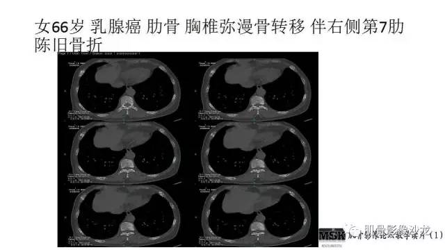 【PPT】肋骨骨折诊断经验分享