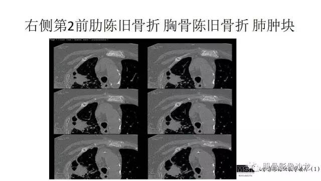 【PPT】肋骨骨折诊断经验分享