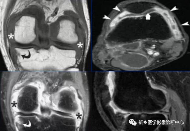 膝关节疾病，应想到的基本5种病变
