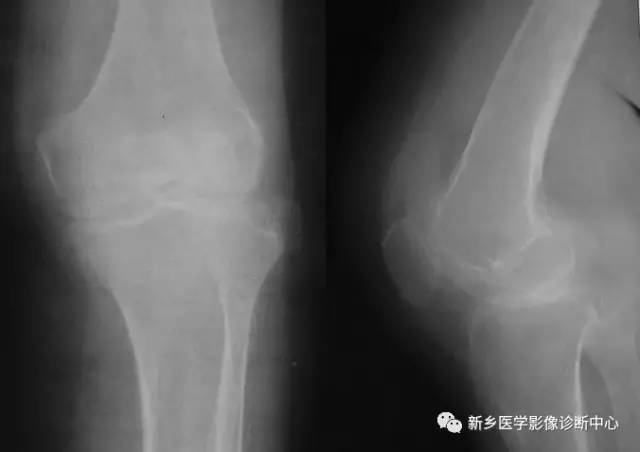 膝关节疾病，应想到的基本5种病变