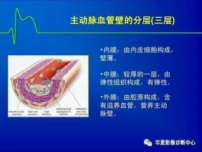 几张图快速认识主动脉夹层