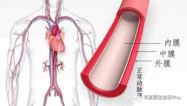 几张图快速认识主动脉夹层