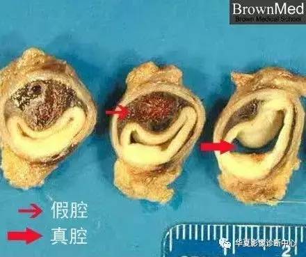 几张图快速认识主动脉夹层