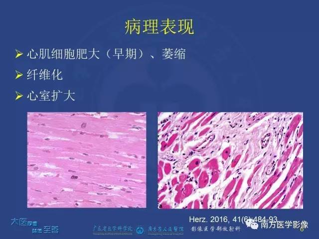 【PPT】酒精性心肌病