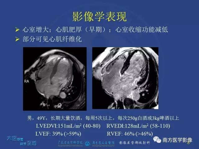 【PPT】酒精性心肌病