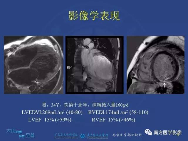【PPT】酒精性心肌病