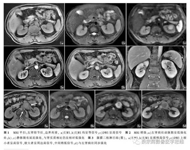 【病例】肾集合管癌1例CT影像诊断思路