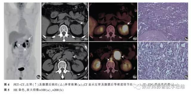 【病例】肾集合管癌1例CT影像诊断思路