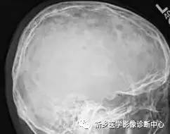 看到颅骨缺损,要想到的26种疾病 看到颅骨缺损,要想到的26种疾病