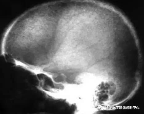看到颅骨缺损,要想到的26种疾病 看到颅骨缺损,要想到的26种疾病