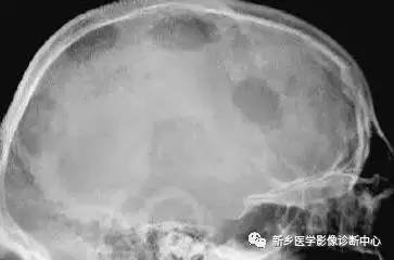 看到颅骨缺损,要想到的26种疾病 看到颅骨缺损,要想到的26种疾病