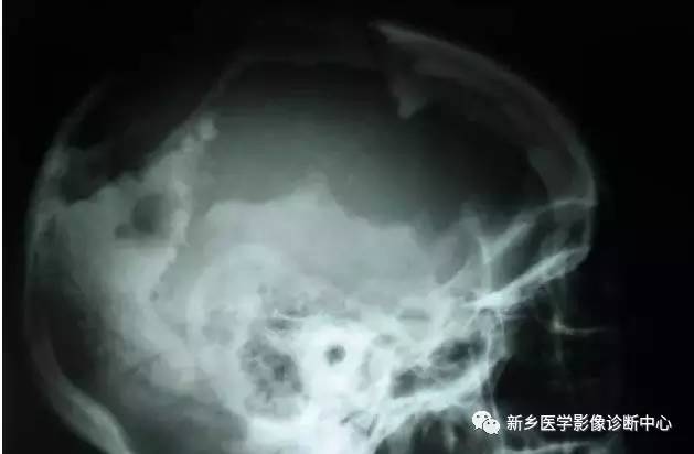 看到颅骨缺损,要想到的26种疾病 看到颅骨缺损,要想到的26种疾病