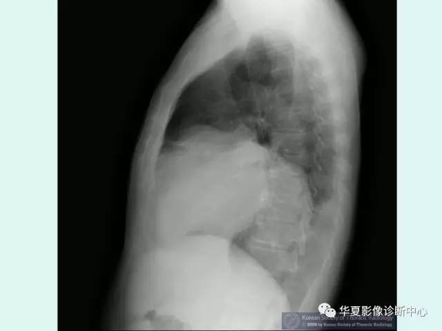 【病例】巨大胸膜纤维瘤一例CT