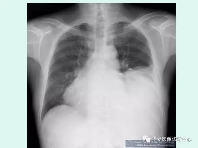 【病例】巨大胸膜纤维瘤一例CT