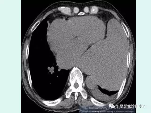 【病例】巨大胸膜纤维瘤一例CT