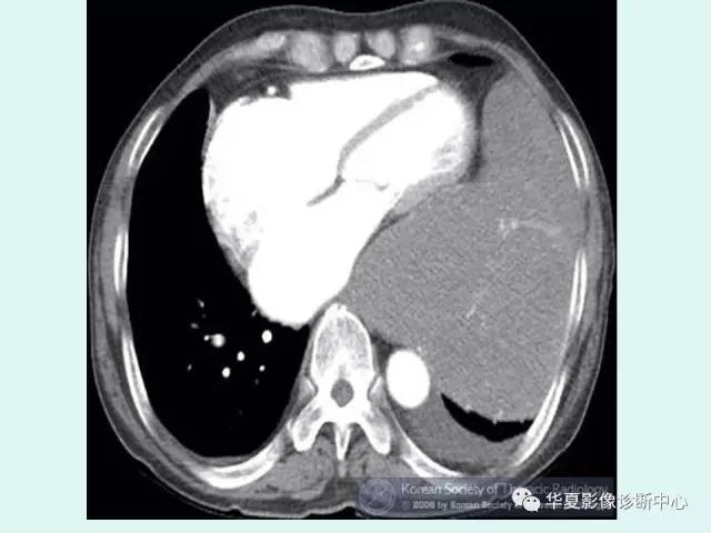 【病例】巨大胸膜纤维瘤一例CT