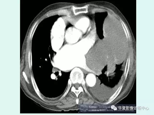 【病例】巨大胸膜纤维瘤一例CT