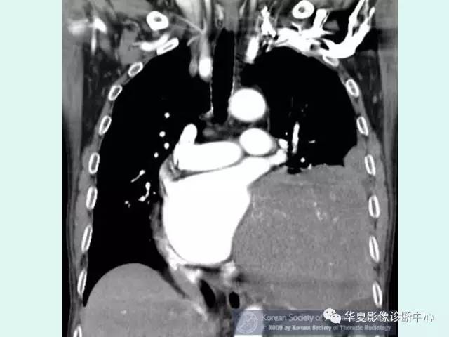 【病例】巨大胸膜纤维瘤一例CT