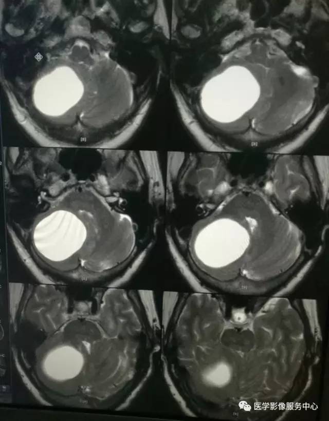 【病例】小脑血管母细胞瘤1例MR影像表现 【病例】小脑血管母细胞瘤1例MR影像表现