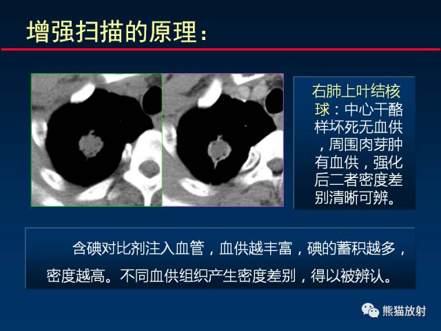【PPT】CT扫描及后处理技术在胸部疾病中的价值