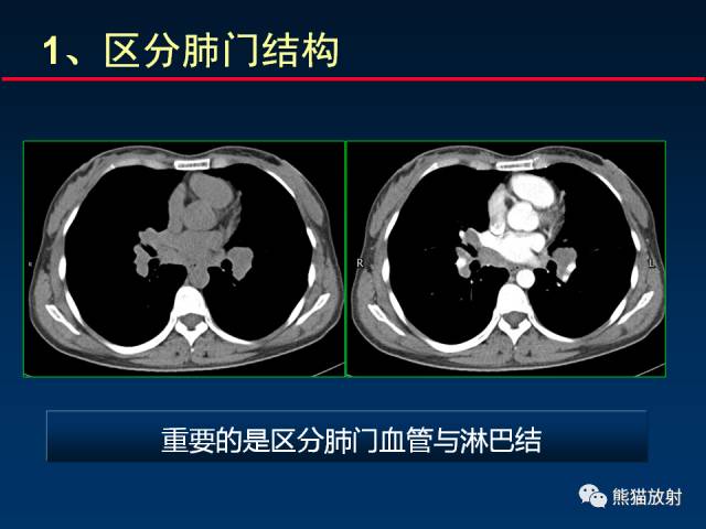 【PPT】CT扫描及后处理技术在胸部疾病中的价值