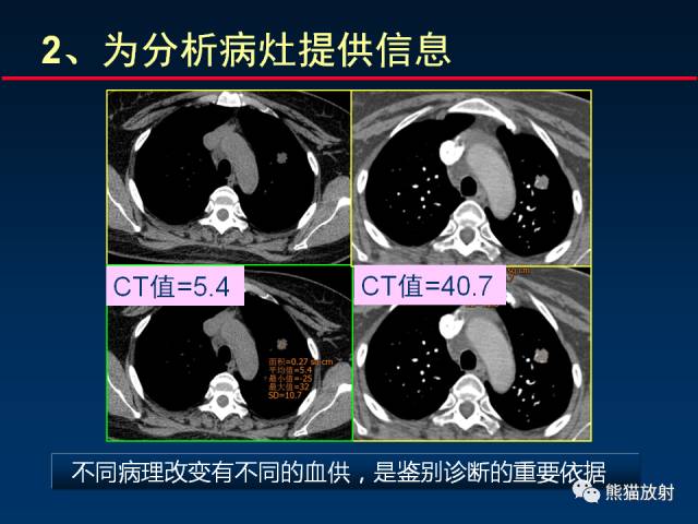 【PPT】CT扫描及后处理技术在胸部疾病中的价值