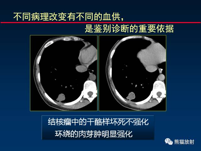 【PPT】CT扫描及后处理技术在胸部疾病中的价值