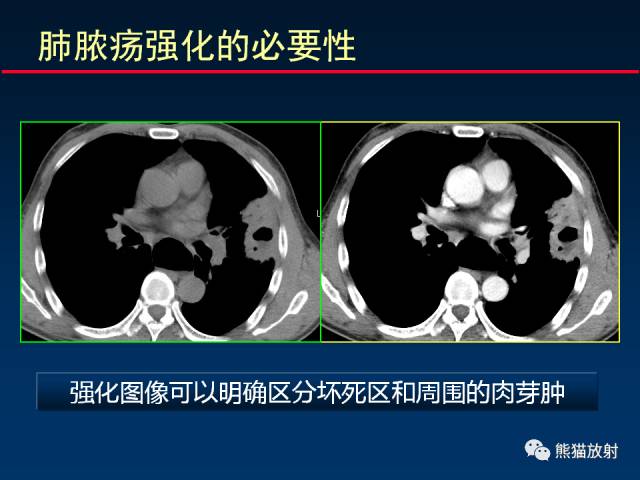 【PPT】CT扫描及后处理技术在胸部疾病中的价值