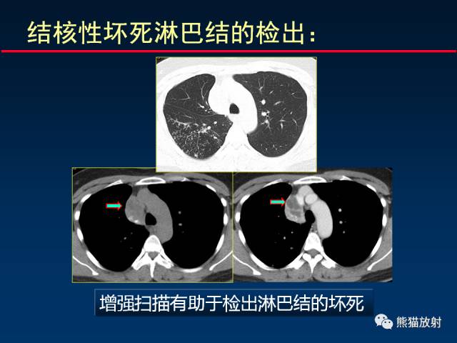 【PPT】CT扫描及后处理技术在胸部疾病中的价值