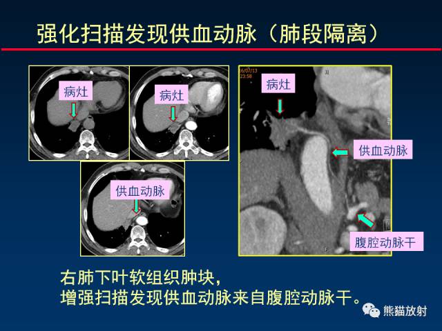 【PPT】CT扫描及后处理技术在胸部疾病中的价值