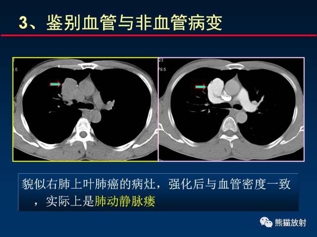 【PPT】CT扫描及后处理技术在胸部疾病中的价值