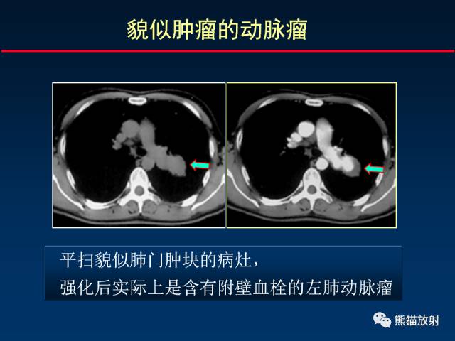 【PPT】CT扫描及后处理技术在胸部疾病中的价值