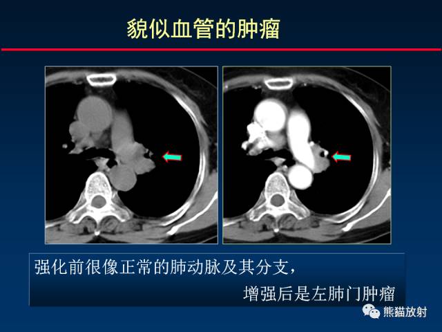 【PPT】CT扫描及后处理技术在胸部疾病中的价值