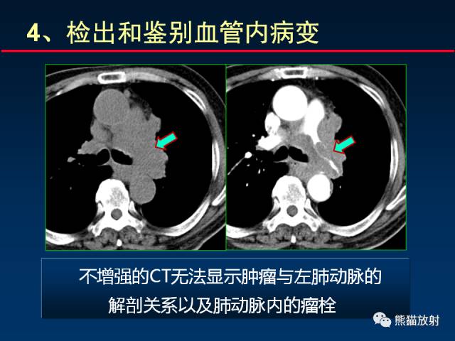 【PPT】CT扫描及后处理技术在胸部疾病中的价值