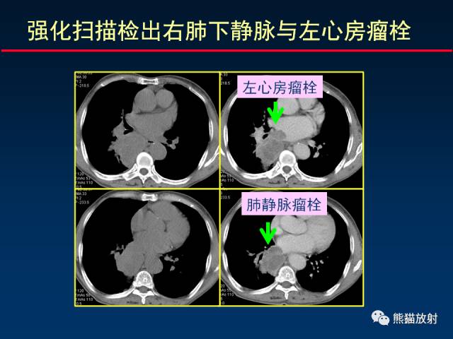 【PPT】CT扫描及后处理技术在胸部疾病中的价值