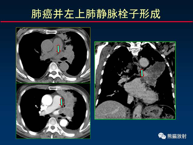 【PPT】CT扫描及后处理技术在胸部疾病中的价值