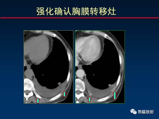 【PPT】CT扫描及后处理技术在胸部疾病中的价值