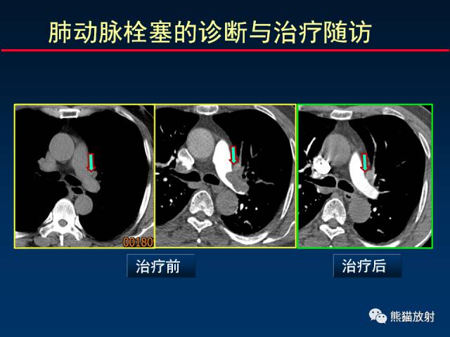 【PPT】CT扫描及后处理技术在胸部疾病中的价值