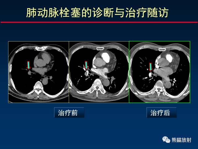 【PPT】CT扫描及后处理技术在胸部疾病中的价值