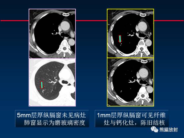 【PPT】CT扫描及后处理技术在胸部疾病中的价值