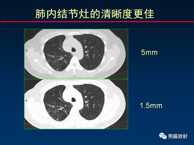 【PPT】CT扫描及后处理技术在胸部疾病中的价值