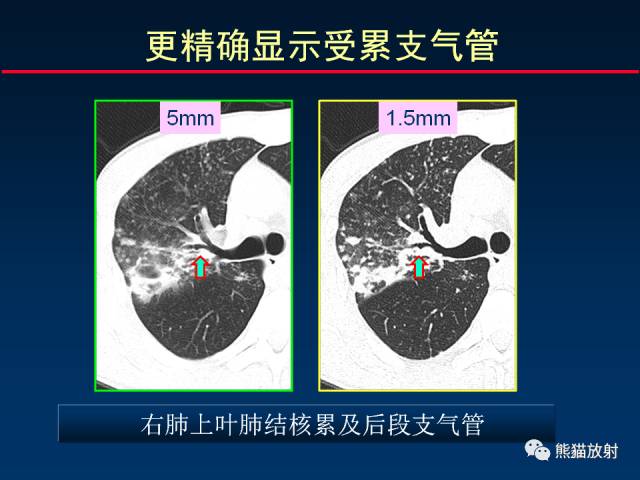 【PPT】CT扫描及后处理技术在胸部疾病中的价值