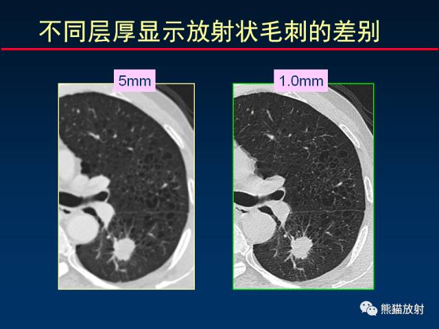【PPT】CT扫描及后处理技术在胸部疾病中的价值